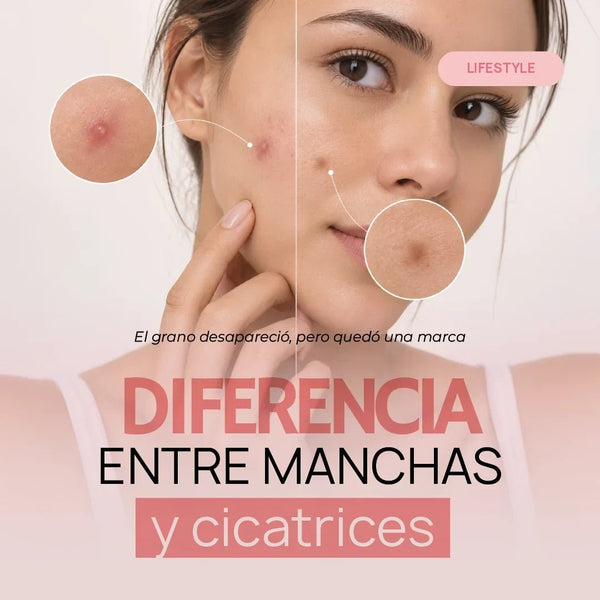 El grano desapareció, pero quedó una marca: diferencias entre manchas y cicatrices